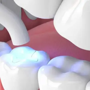 mòn cổ chân răng