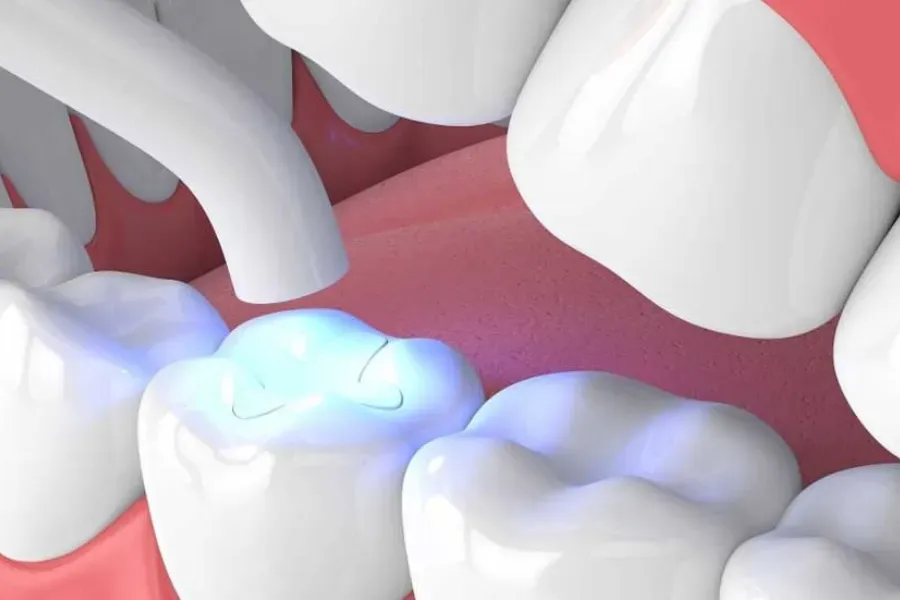 Cách giúp miếng trám mòn cổ chân răng chắc, không bị bung