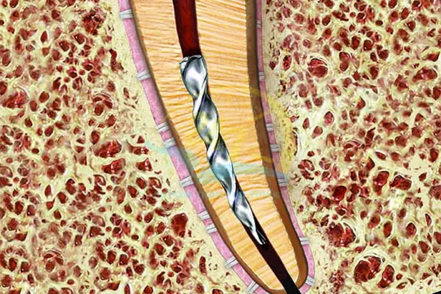 làm sạch ống tủy bằng file tay