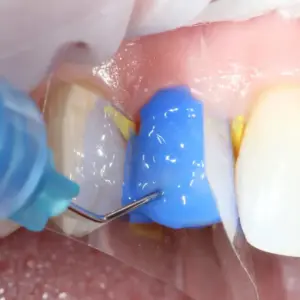 Tìm hiểu etching nha khoa là gì? - Etching nha khoa la gi 4