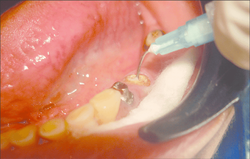 bơm rửa ống tủy bằng kim bơm rửa