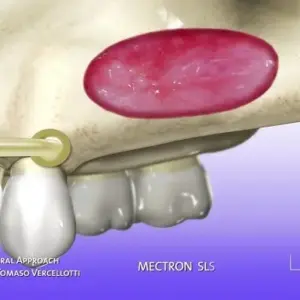 Máy phẫu thuật siêu âm – bước tiến vượt bậc trong phẫu thuật nha khoa hiện đại