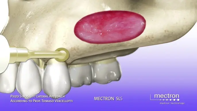 Máy phẫu thuật siêu âm – bước tiến vượt bậc trong phẫu thuật nha khoa hiện đại