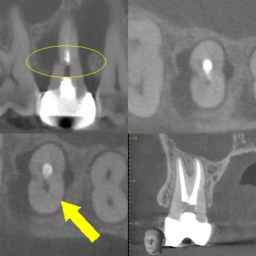 ứng dụng CBCT trong retreatment