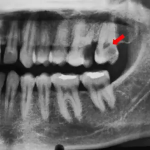phim chụp ống tủy chữ C