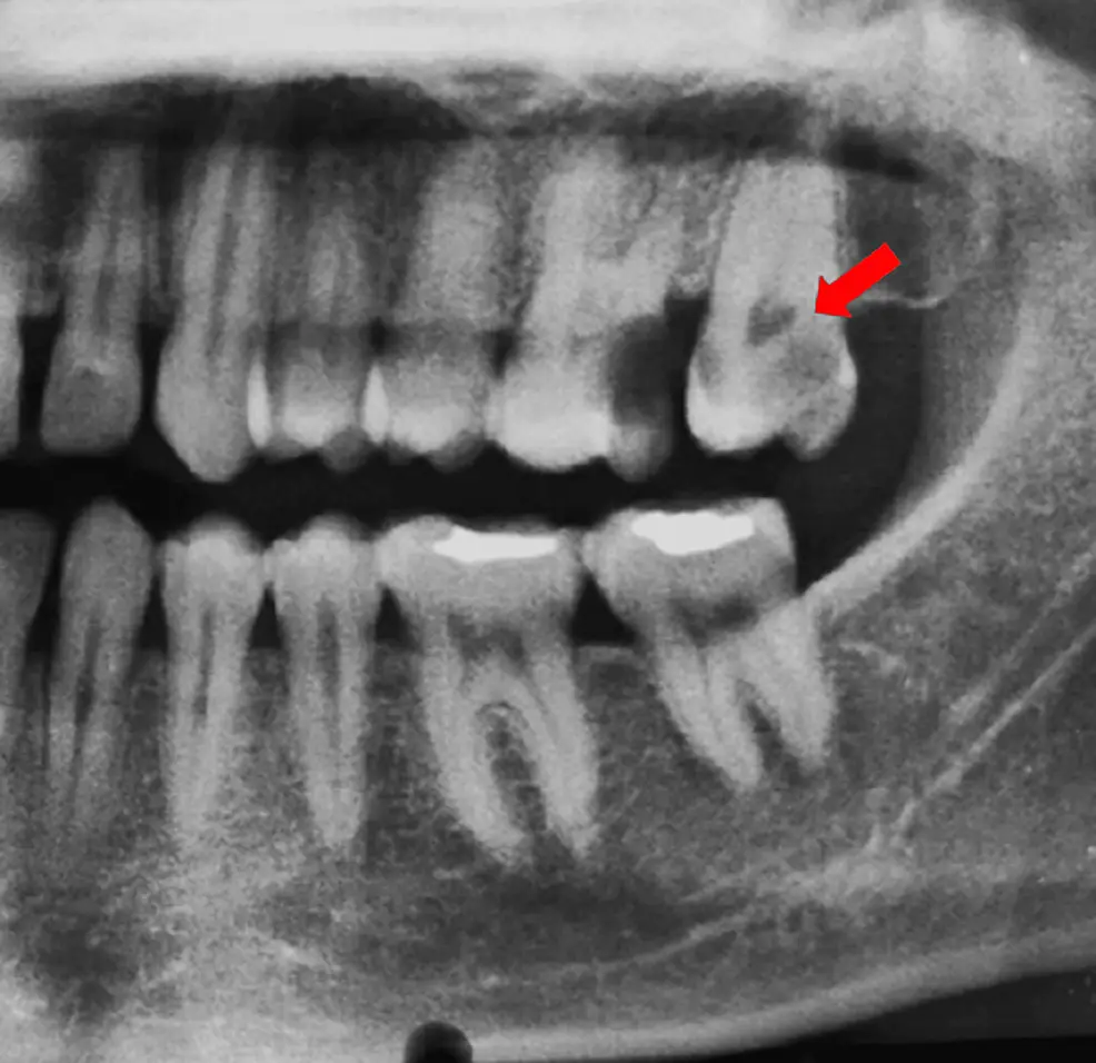 Vai trò của CBCT trong điều trị ống tủy hình chữ c