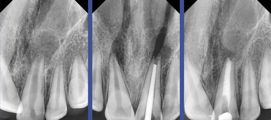 Bioceramic không gây độc cho tế bào, kích thích tái tạo và lành thương quanh chóp