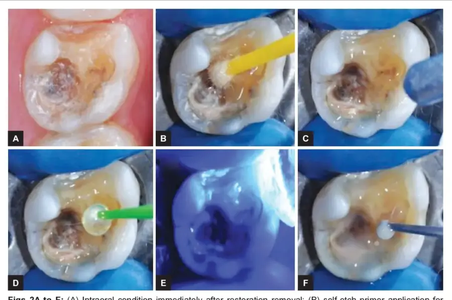 phục hình gián tiếp
