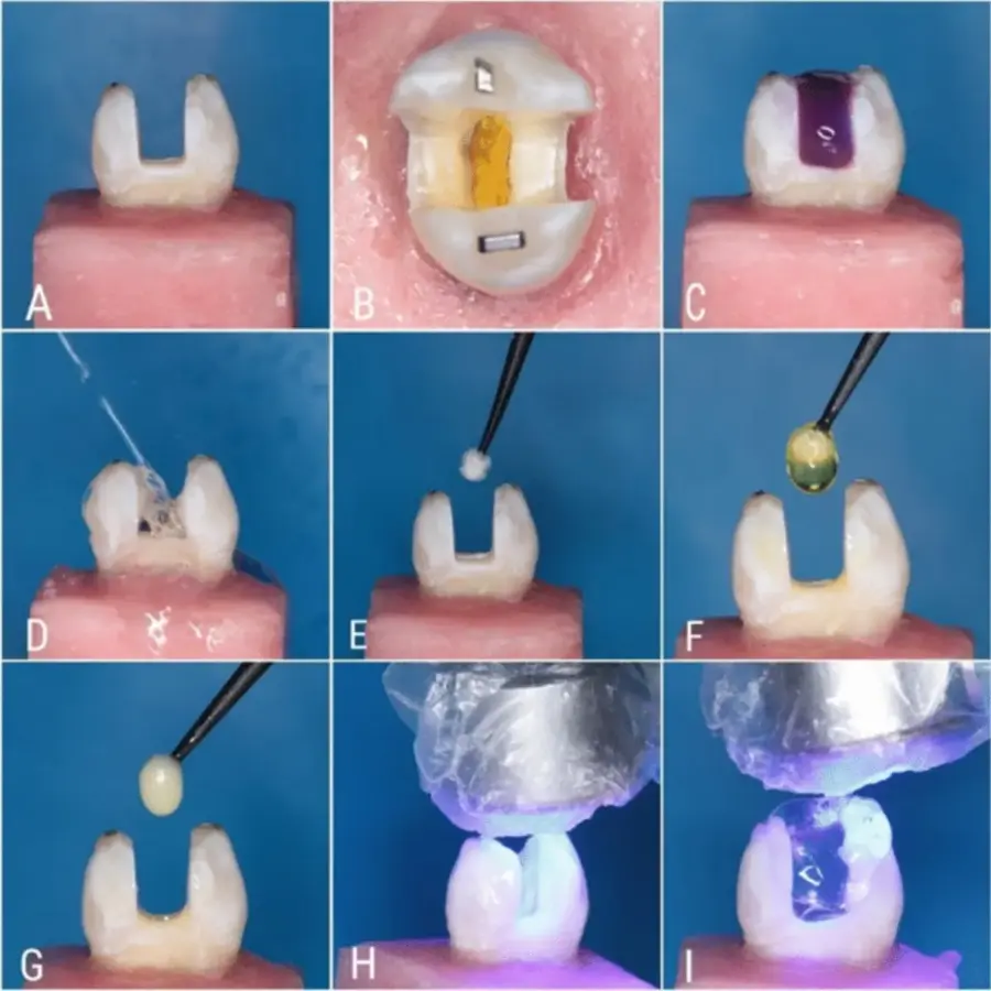 Immediate Dentin Sealing – IDS