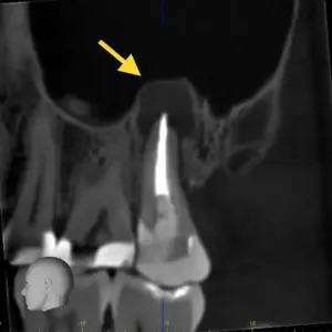 Chẩn đoán ống tủy phức tạp với CBCT Morita veraview x800 - Root canal xray02