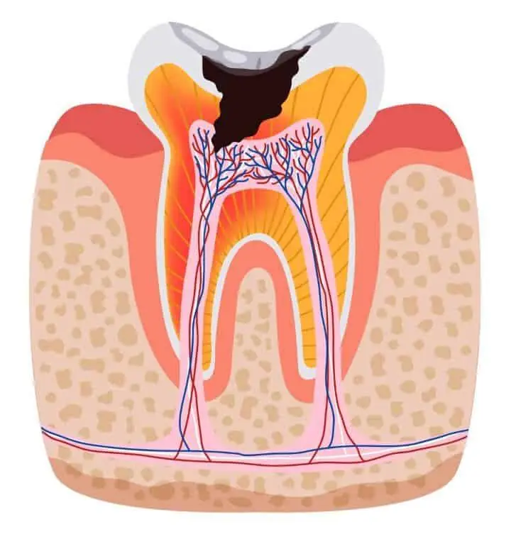 Ảnh hưởng của vi kẽ trong phục hình cố định và các biện pháp phòng ngừa - Viem tuy