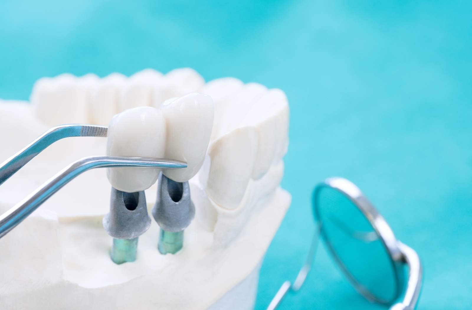 Xử lý bề mặt răng trong gắn kết phục hình sứ: quy trình lâm sàng - How to Clean Care For a Dental Bridge Hero