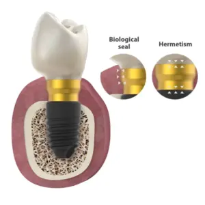 BTI BioBlock Prosthetics - Giải pháp phục hình implant