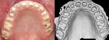 Tìm hiểu các phương pháp xác định chính xác trong phục hình toàn hàm và các sai lầm thường gặp giúp bác sĩ tối ưu kết quả điều trị và thẩm mỹ cho bệnh nhân.