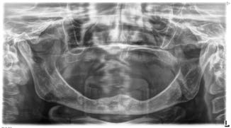 Mức tiêu xương viền quanh Implant ngắn 6.5mm BTI