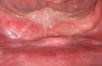 X-quang ban đầu tiêu xương dọc