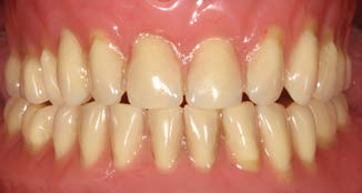 Khớp cắn mất cân đối