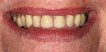 Hàm mất răng toàn bộ