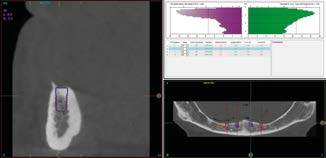Lên kế hoạch cấy ghép Implant ngắn 6.5mm BTI