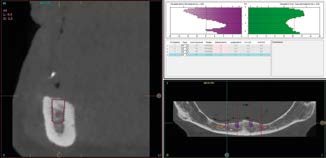 Kế hoạch định vị 4 Implant ngắn 6.5mm BTI