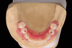 Wax-up chẩn đoán phục hình tạm