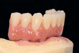 Khung phục hình chịu lực tức thì