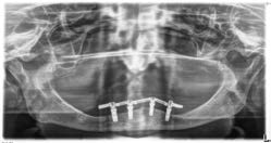 Bệnh nhân tiêu xương dọc sau phục hình