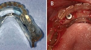 máng hướng dẫn phẫu thuật implant