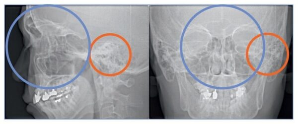 Máy chụp cắt lớp Cone Beam CT 3D Accuitomo 170 - MORITA