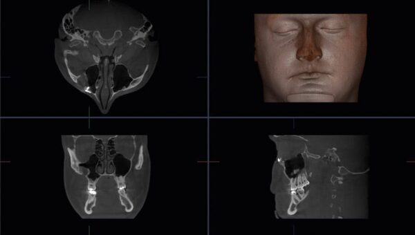 Máy chụp cắt lớp Cone Beam CT 3D Accuitomo 170 - MORITA
