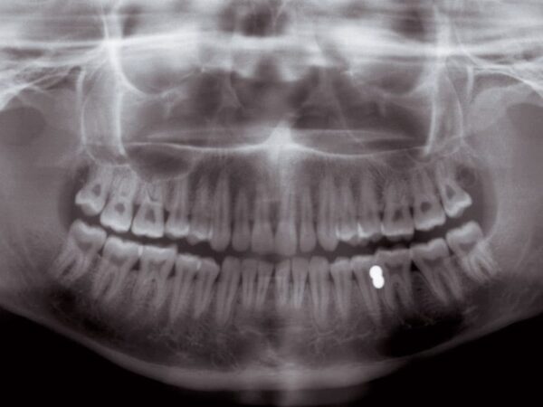 Máy X-quang toàn cảnh nha khoa Veraviewepocs 2D - MORITA