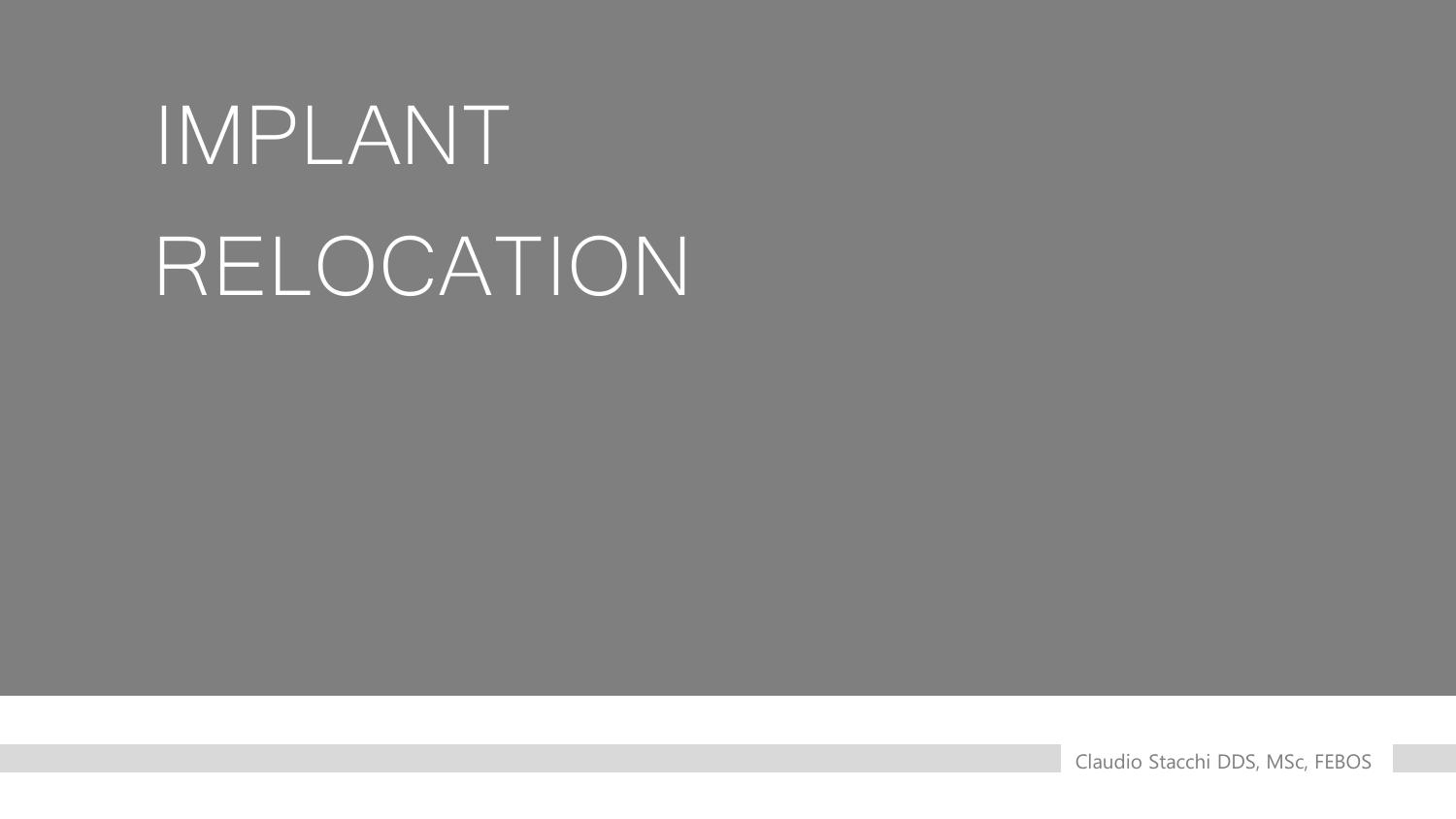 Giới thiệu kỹ thuật Implant Relocation