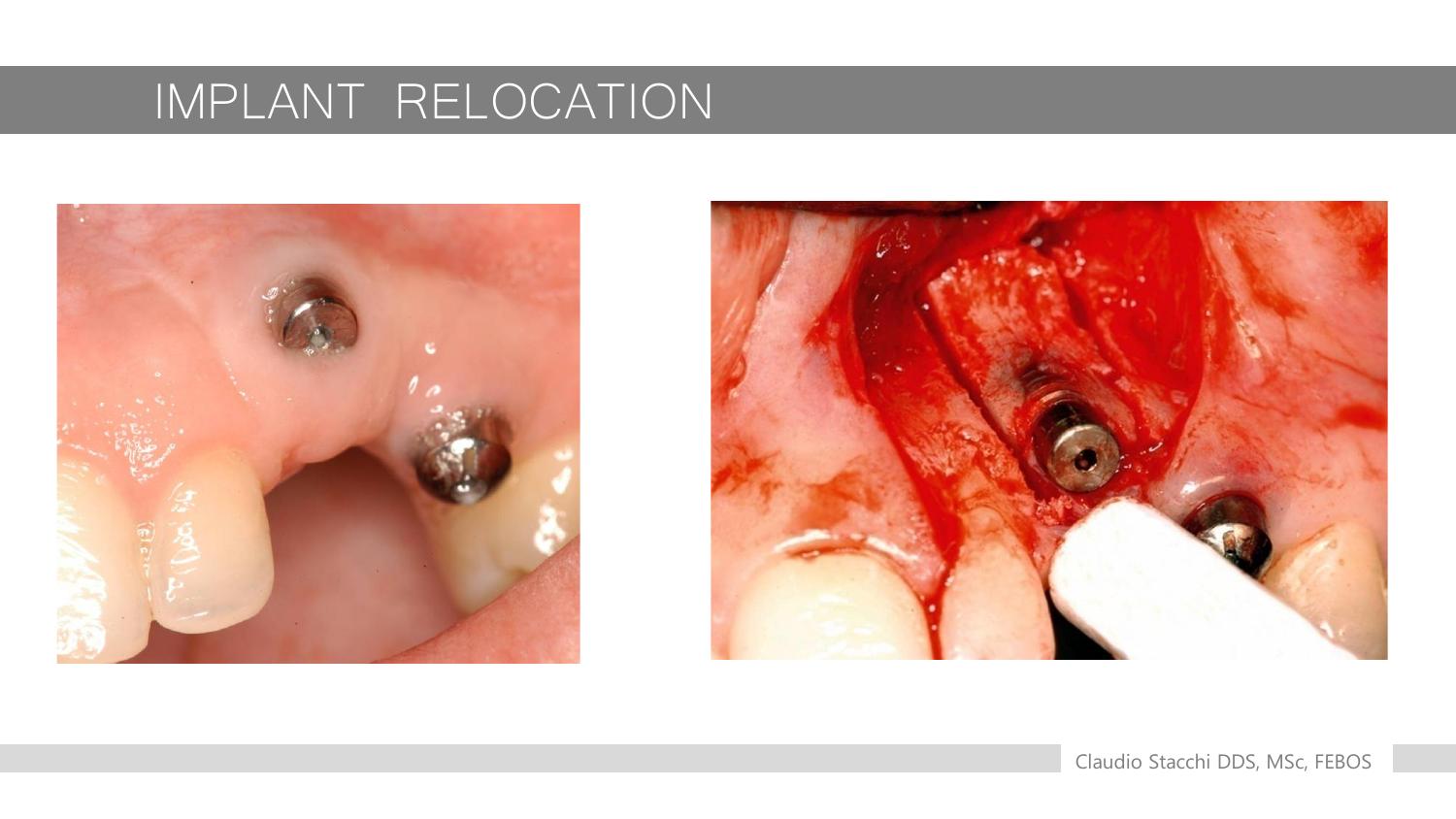 Implant Relocation - trước và sau phẫu thuật