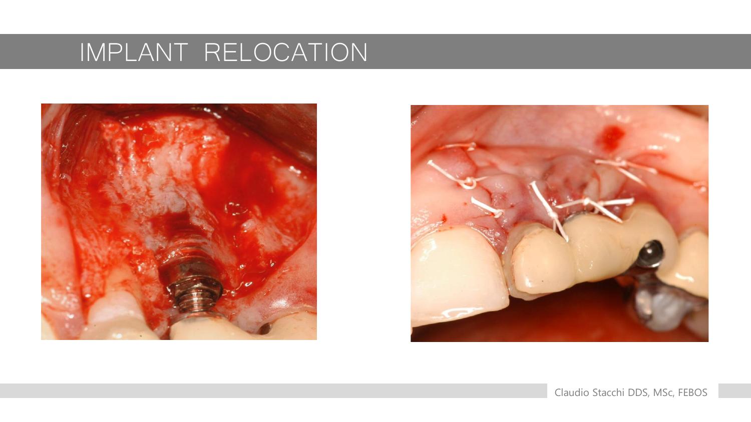 Kỹ thuật Implant Relocation - ca lâm sàng minh họa nguyên lý gãy cành tươi