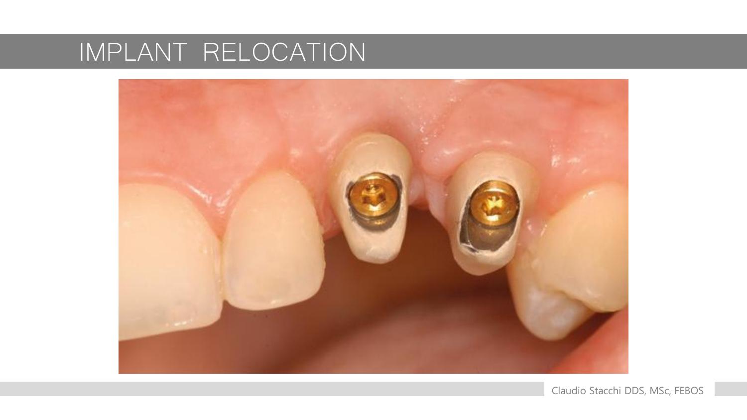 Implant Relocation - đường cắt xương bằng OT 12