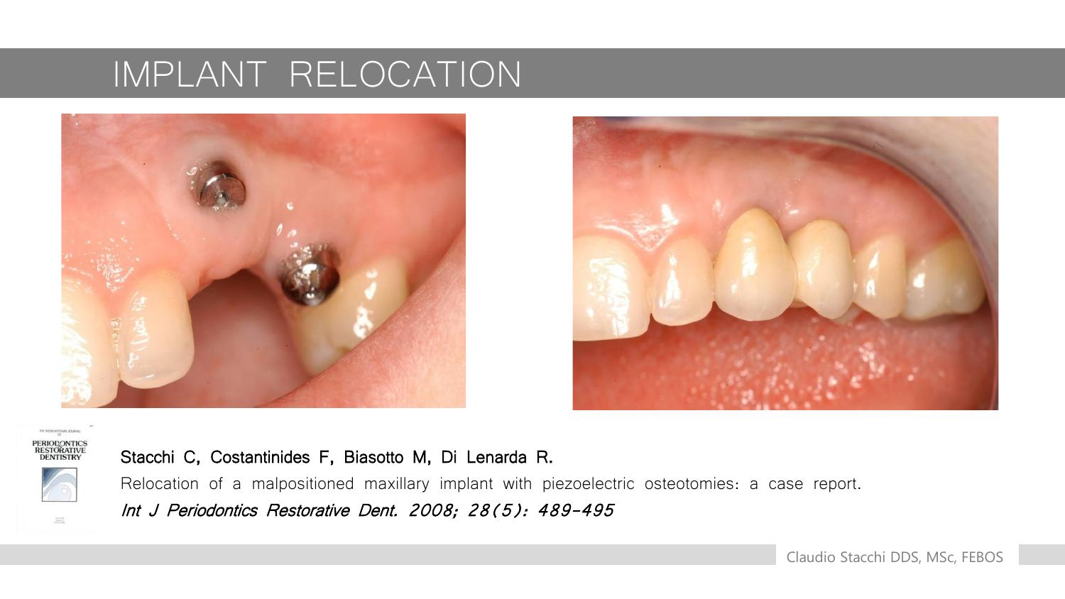 Implant Relocation - kết quả phục hình sau di dời