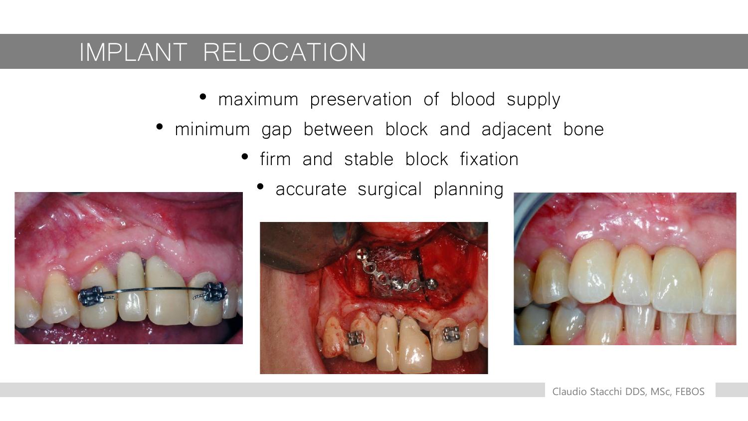 Ca lâm sàng: di dời khối xương và nẹp cố định
